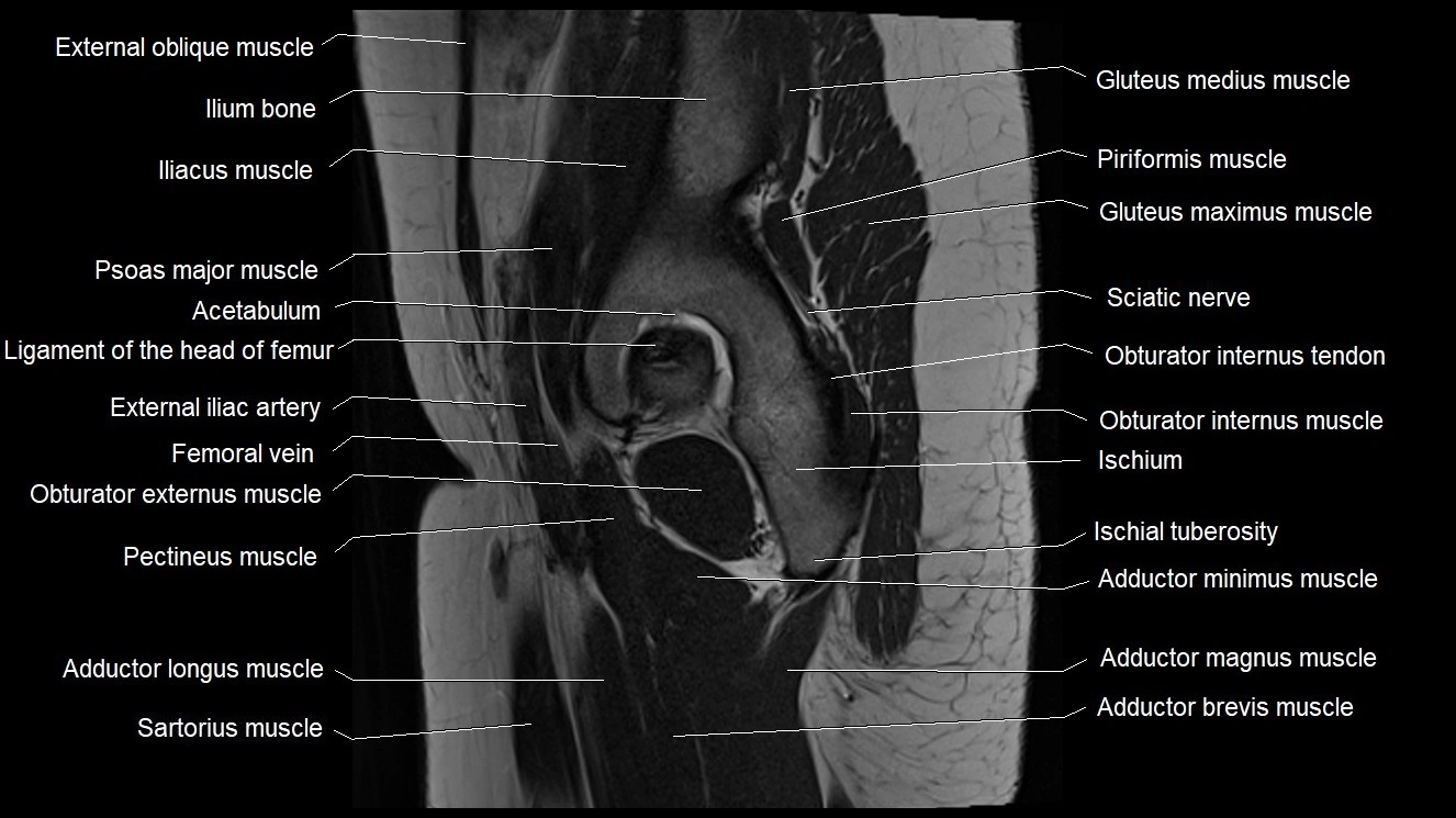Hip sagittal cross sectional anatomy image 23.webp